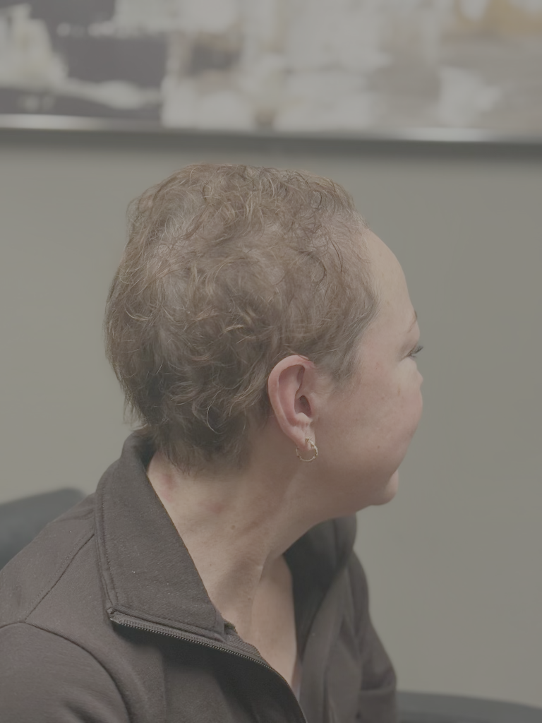 After hair restoration 1