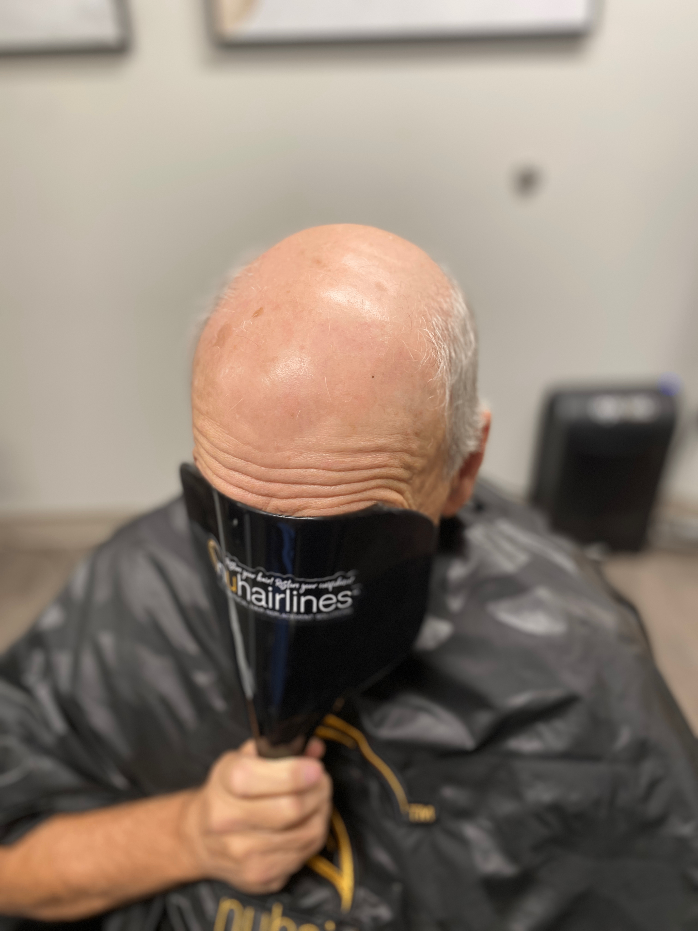 Before hair restoration 4
