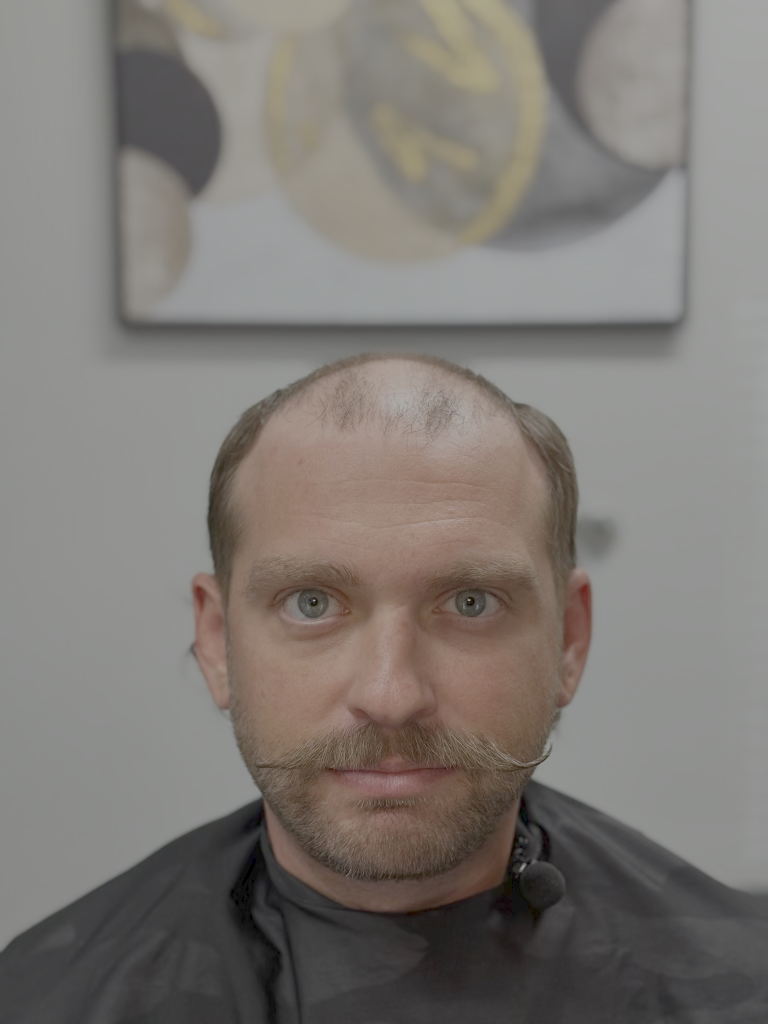 Before hair restoration 2