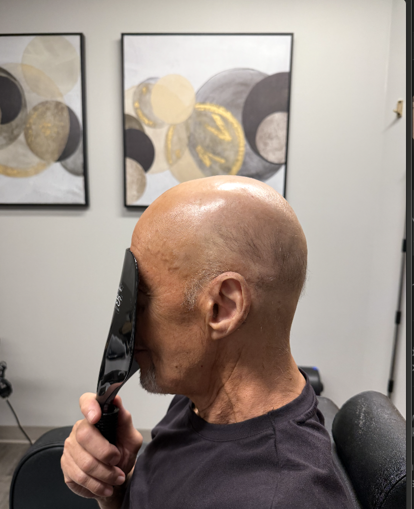 Before hair restoration 5