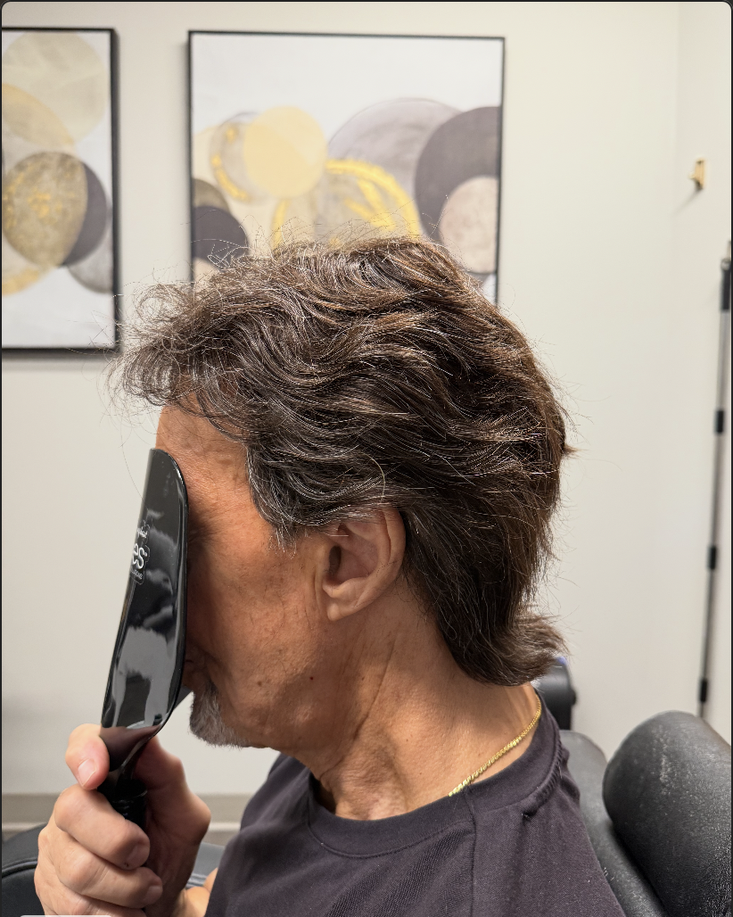 After hair restoration 5