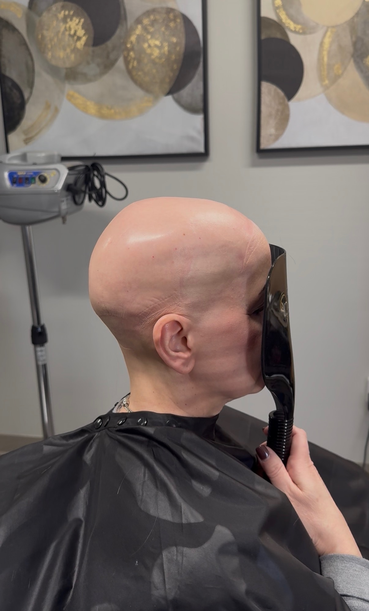 After hair restoration 3